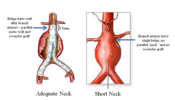 Aorta Aneurysm Surgery